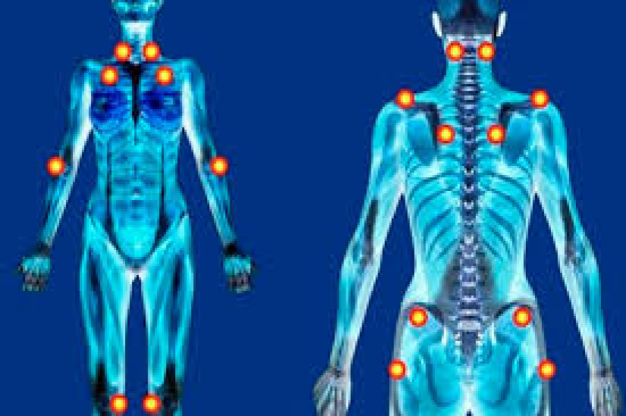 Novas diretrizes ampliam o tratamento de fibromialgia pelo SUS