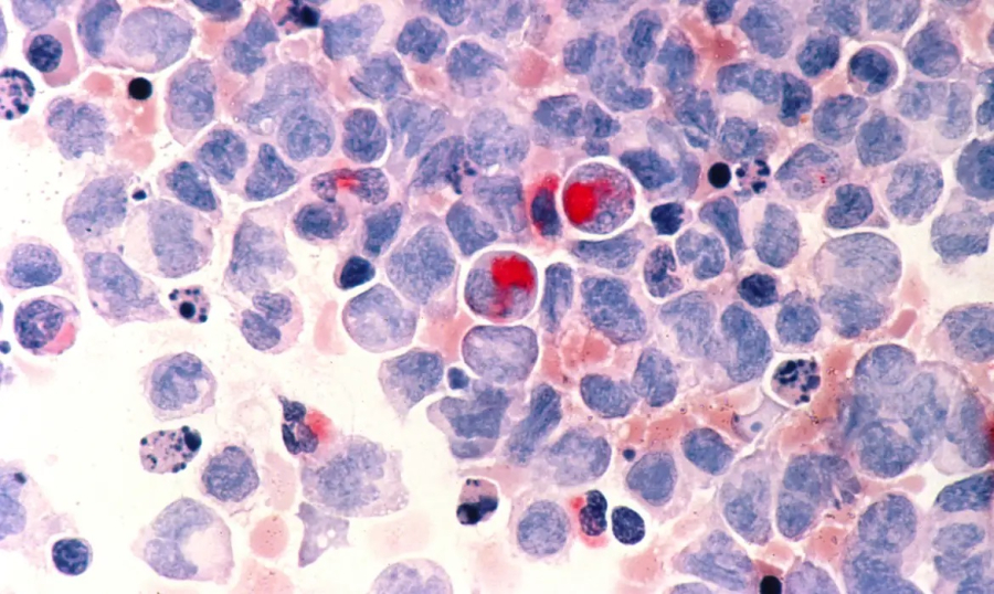 Fevereiro Laranja conscientiza sobre importância da doação de medula