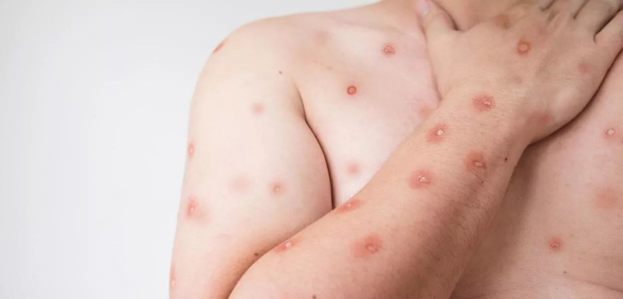 Mpox avança no Brasil e região lidera com número de casos