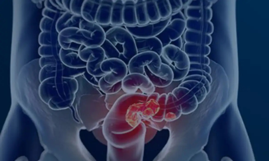 Campanha Março Azul alerta para a prevenção do câncer colorretal